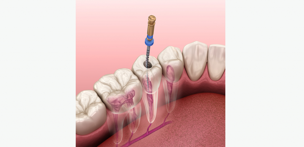 Endodontie / Füllungen - Zahnarztpraxis Bopp & Kollegen